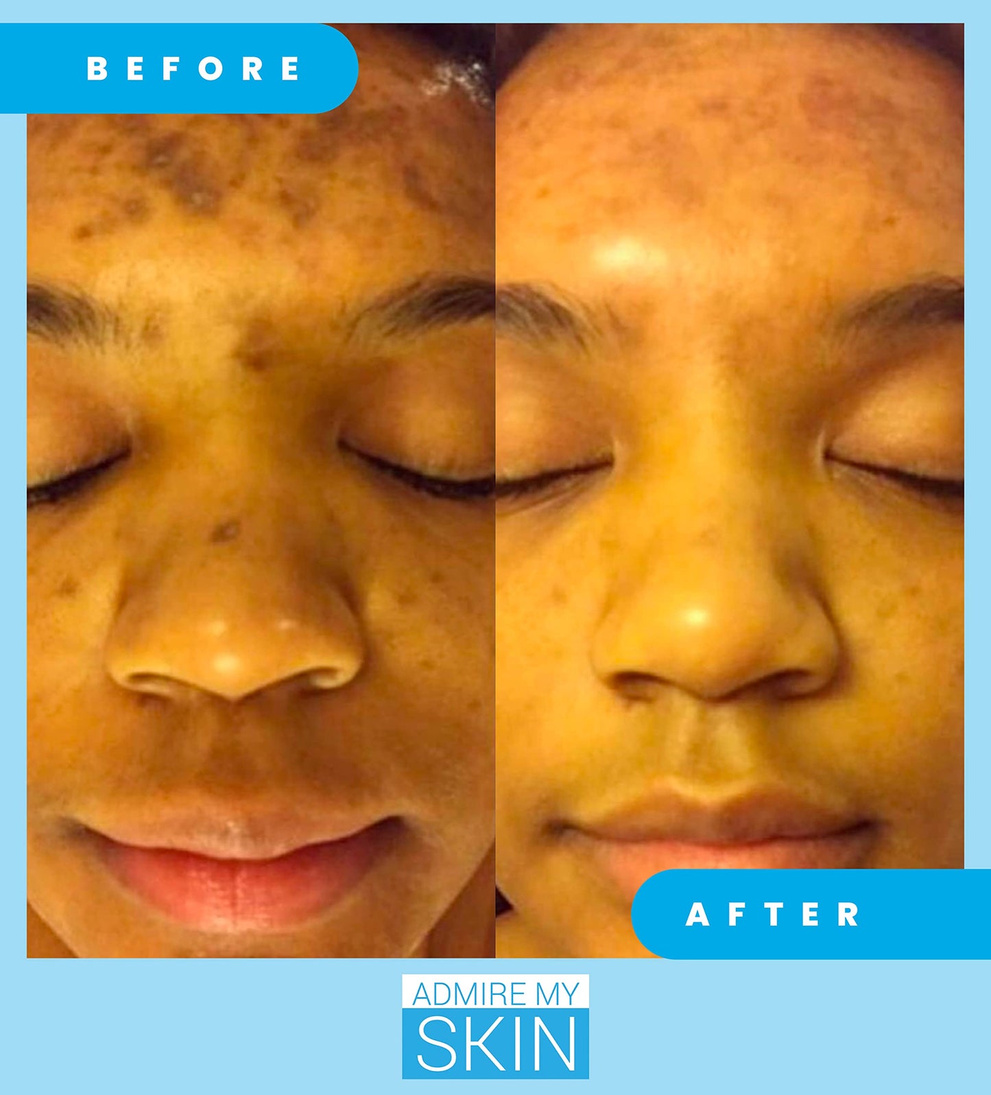 Admire My Skin Dark Spot Remover + Retinoid Cream + Vitamin C Oil